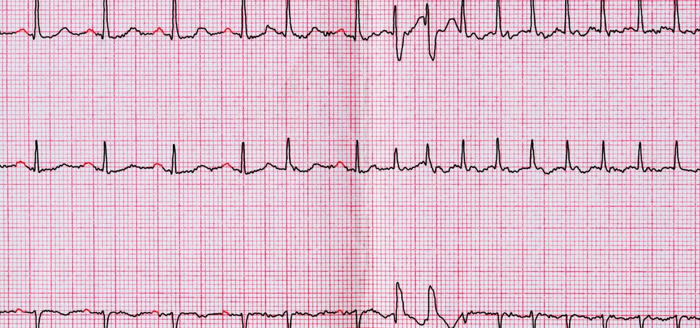Food and Fibrillation: How Your Diet Affects Atrial Fibrillation Risk