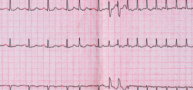 Food and Fibrillation: How Your Diet Affects Atrial Fibrillation Risk