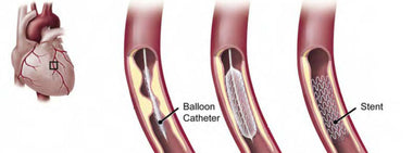 Stent Balloon Catheter Science Graphic