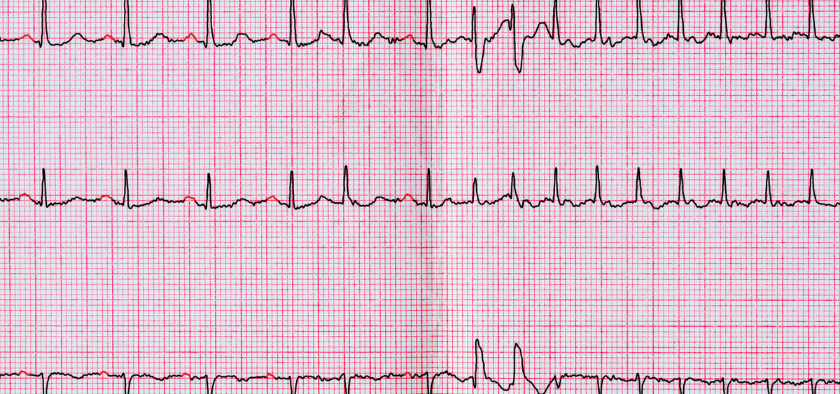 Food and Fibrillation: How Your Diet Affects Your AFib Risk