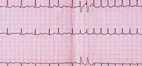 Food and Fibrillation: How Your Diet Affects Atrial Fibrillation Risk