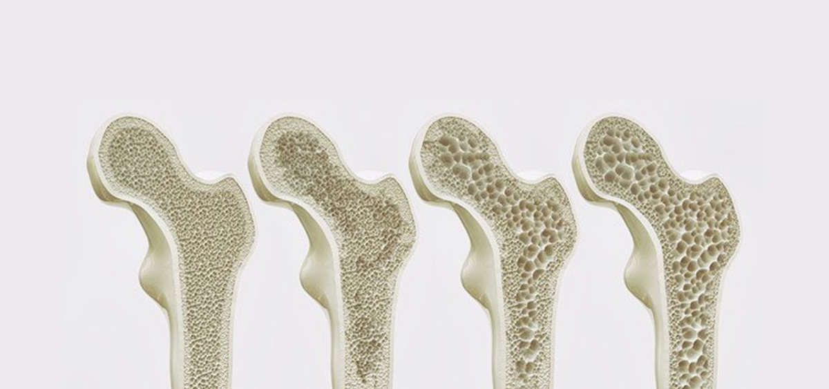 Bone Density Score: The One Number Where Higher Is Better