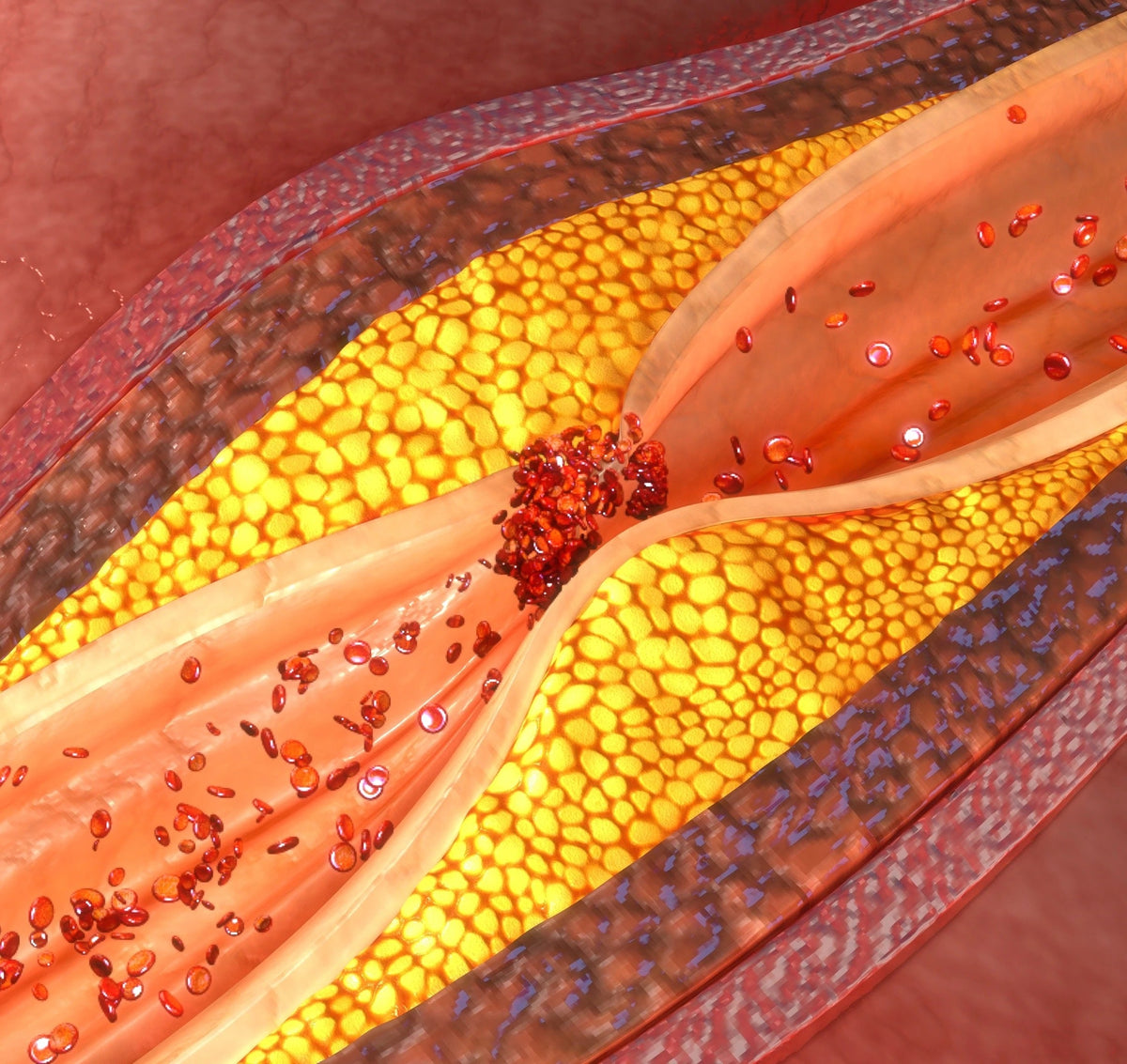 Cross-section illustration of cholesterol plaque building up inside an artery