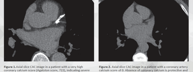 What You Need to Know About Coronary Calcium Scans