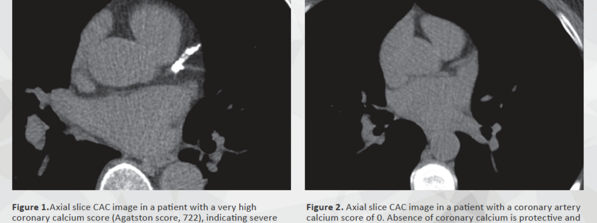 A coronary calcium scan checks for plaque in the heart's arteries