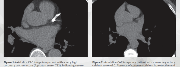 A coronary calcium scan checks for plaque in the heart's arteries